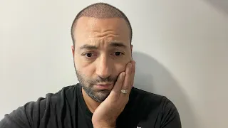 This is What Happened to My Hair 10 Days After Hair Transplant Surgery (shocking)