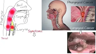 Throat cancer - Symptoms, causes and Treatment.  Laryngeal Cancer and Pharyngeal Cancer