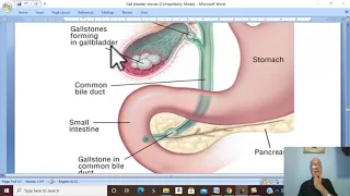 Biliary  disorders in Arabic 3 ( Complications of Gall Bladder Stones ) , by Dr. Wahdan