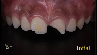 Class IV restorations using layering technique , trauma of central incisors for a boy