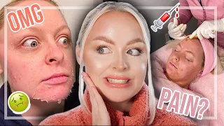 CHEMICAL PEEL & BOTOX EXPERIENCE VLOG | VI PEEL PURIFY PRECISION PLUS + DYSPORT FIRST TIME! | MCDREW