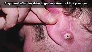 Amazing Ear Blackheads... Just Wait For It!