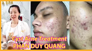 Cyst Acne Treatment | Điều trị mụn hiệu quả số 1 TPHCM | Hiền Vân Spa | Phan Duy Quang| 553