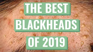 Mr.Blackhead’s Best Extractions for 2019 Compilation + Q&A