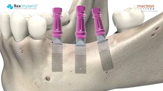 IMPLANTOLOGY - REX PIEZOIMPLANT ANIMATION - Clinical protocol for the preparation of implant site