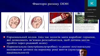 Дисплазія кульшового суглоба. Вивих стегна. Лікування  / DDH. Dislocation of the Hip. Treatment.