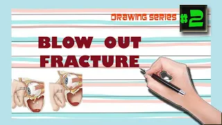 Blowout fracture|Brief Explanation and Easy diagrams|OMFS|Final year|Bibliodent