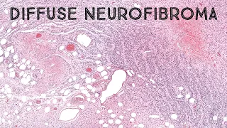 Diffuse neurofibroma in neurofibromatosis NF1 (round nuclei & tiger stripe pattern) pathology