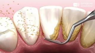 Профессиональная чистка зубов