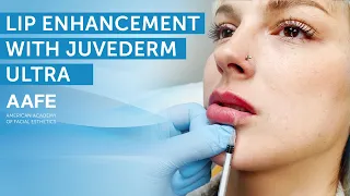 Adding More Lip Volume with Juvederm Ultra! | AAFE