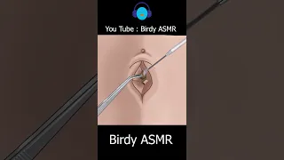 ASMR Remove Huge navel stone #asmr #animation #satisfying #shorts