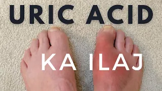 Uric acid treatment | Uric acid foods to avoid | Uric acid ka ilaj | How to reduce uric acid at home