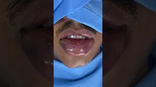 Large Deformed Lower Lip Tumor Filled With Blood Corrected with Plasticsurgery - Before and After