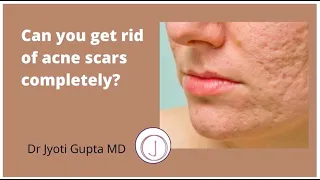 Can you get rid of acne scars completely? | Acne Scar Removal Treatment | Dr. Jyoti Gupta