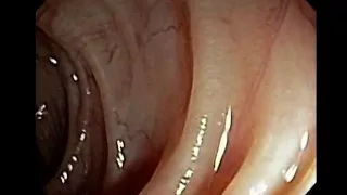 Colonoscopy of Diverticular Disease