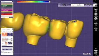 EXOCAD коронки и мост на винтовой фиксации