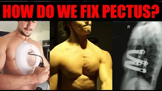 Pectus Excavatum Treatment Options (SURGERY or EXERCISE or VACUUM BELL!?)