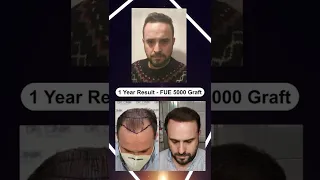 Dr.Cinik Hair Transplant | FUE | Before After 5000 Grafts | Hair Growth Results in 1 Year