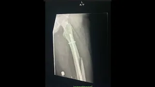 Broken Femur Recovery