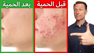 أسرع طريقة للتخلص من حب الشباب | الحل الجذري