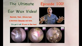 The Ultimate Ear Wax Video! Episode 100 #earwax #keratosisobturans #fungal #ear #earwaxremoval