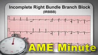 AME Minute:  When is a Special Issuance required under BasicMed?