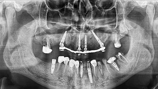 Digital implantology. All-on-4. Mis Implants. Dziuba Implant Studio.