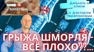 Насколько опасны грыжи Шморля? НЕ ДАЙТЕ ВАС ПУГАТЬ!