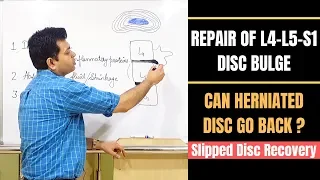 Repair Of Disc Bulge, Can Herniated Disc Heal? Lumbar Disc Herniation Recovery, Slipped Disc Heal?