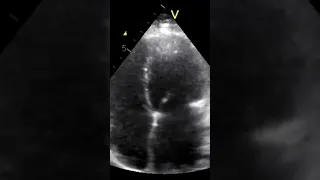 Restrictive Cardiomyopathy