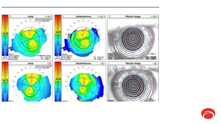 Using specialty soft lenses to enhance optometric practice growth with Dr. Moshe Schwartz