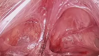 Reverse Vesicouterine Fold Dissection