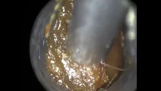 29 - Fully Occluding Dark Ear Wax Removal