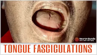 TONGUE FASCICULATIONS #tonguetwitching #motorNeurondisease #ALS #lowermotorneuron #examination