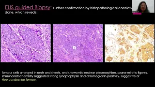 Bhukya Tejaswi | Extra pancreatic neuroendocrine tumors #mriteachingcourse