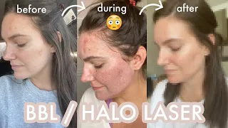 my latest attempt to fix my skin | BBL + Halo experience with prices! | sarah brithinee