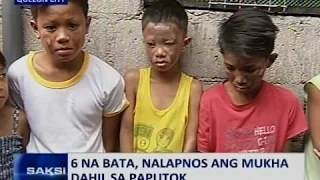 Saksi: 6 na bata, nalapnos ang mukha dahil sa paputok