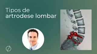 Tipos de artrodese lombar: Especialista responde