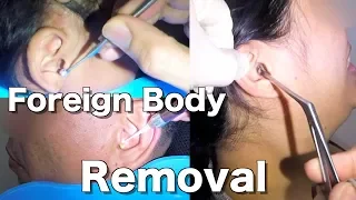 Removal of Foreign Body Stuck from People's Ears Compilation
