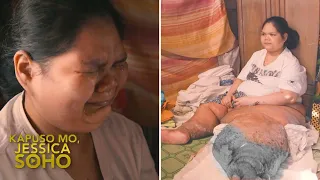 Babae sa Laguna, bakit lumobo ang kaliwang binti at paa? | Kapuso Mo, Jessica Soho