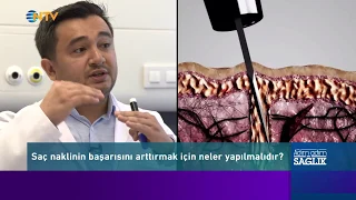 FUE Yöntemiyle Saç Ekimi Nasıl Yapılır?