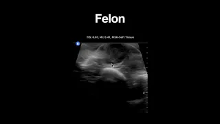 Identification of A Felon Using Ultrasound