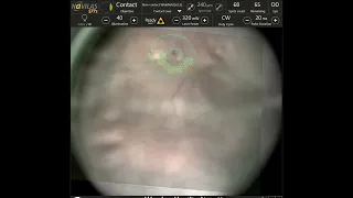 Non-contact navigated laser photocoagulation of peripheral retinal tear with central corneal opacity