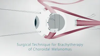 Surgical Technique for Brachytherapy of Choroidal Melanomas