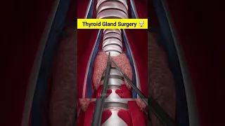 Thyroid Gland Surgery ASMR ANIMATION #shorts #asmr #animation
