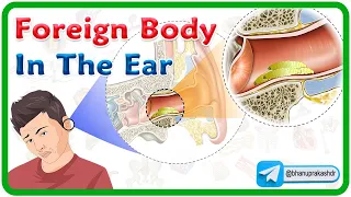 Foreign Body In The Ear Animation 👂👂👂