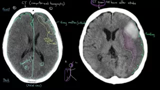 Khan Academy - Diagnosing Strokes with Imaging (CT, MRI, and Angiography)