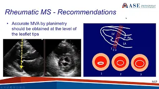 ASE Guideline: Recommendations for the Use of Echo in the Evaluation of Rheumatic Heart Disease