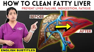 How to Cure Fatty Liver | கல்லீரலில்  கொழுப்பை சுத்தம் செய்வது எப்படி | Dr. Deepthi Jammi