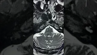 Pitfall of normal cerebellar structure